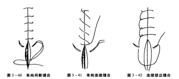 皮下连续缝合示意图图片